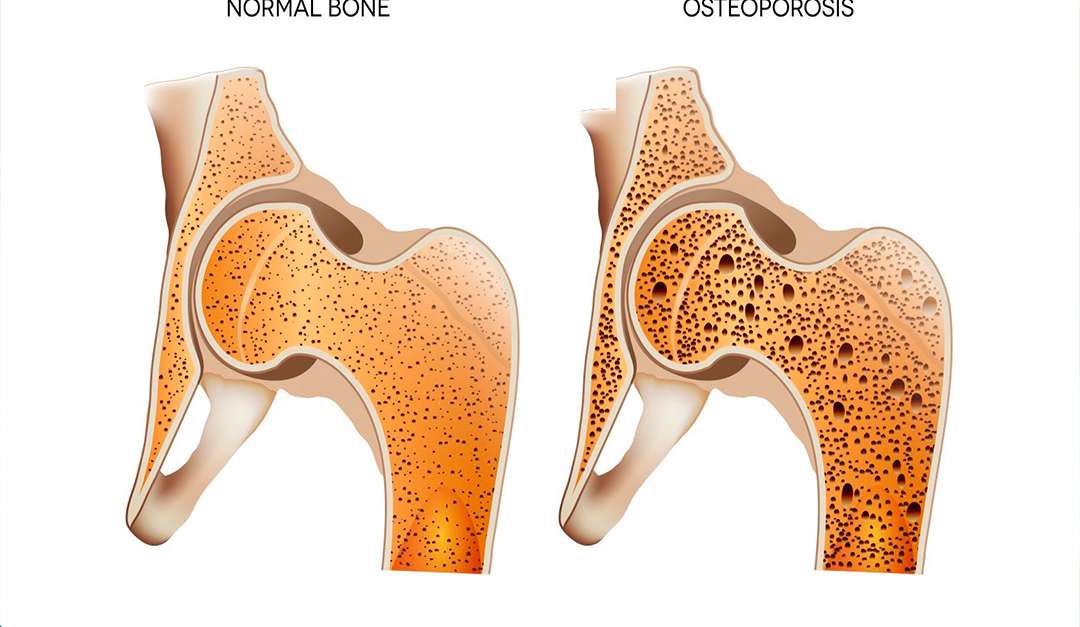 O que é osteoporose?