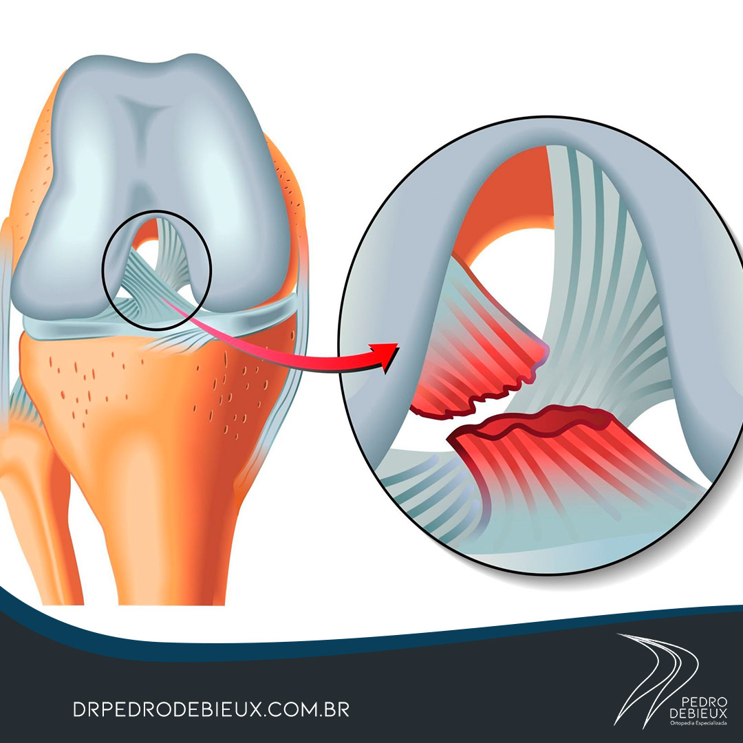 Conhecendo o Ligamento Cruzado Anterior (LCA)